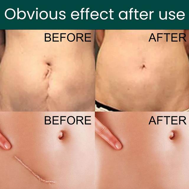 GlowOasis Silicone Scar Sheets