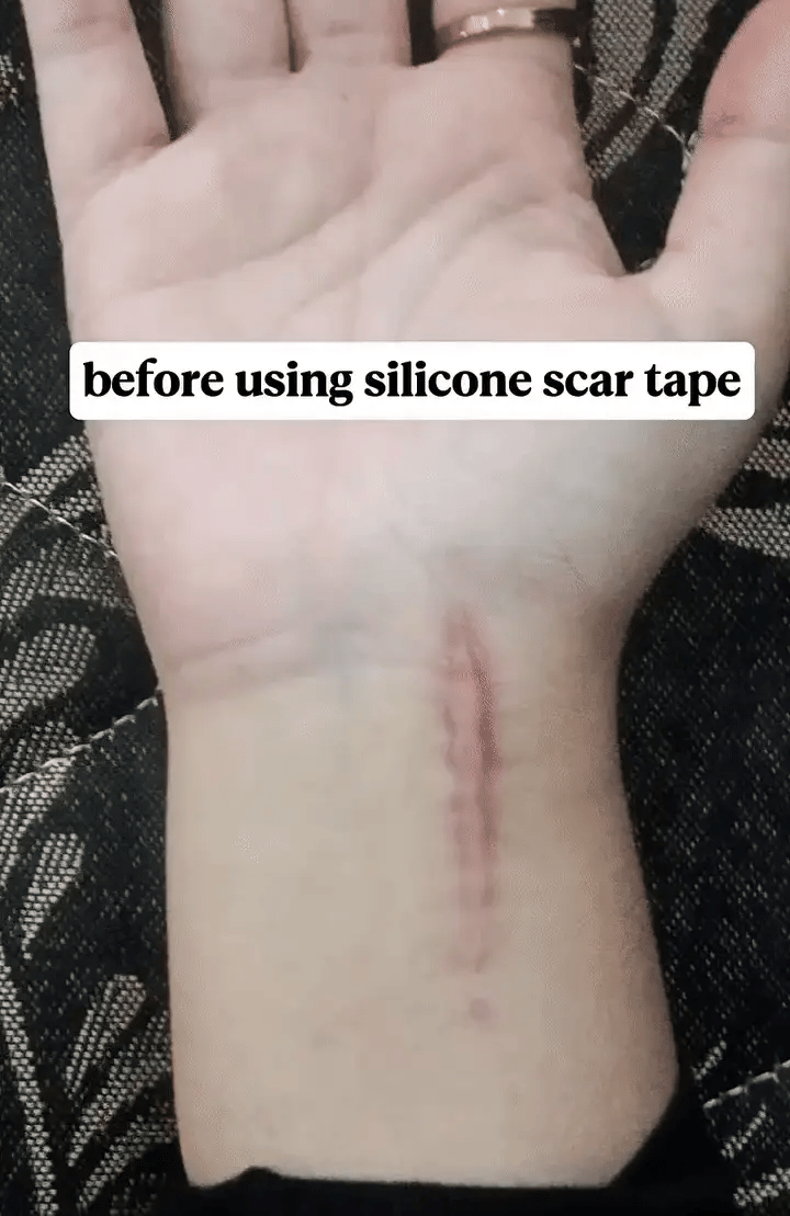 GlowOasis Silicone Scar Sheets