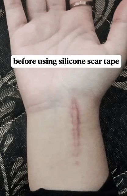 GlowOasis Silicone Scar Sheets